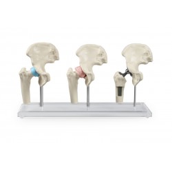 3 modèles du joint de hanche - sain, malade, implant avec support