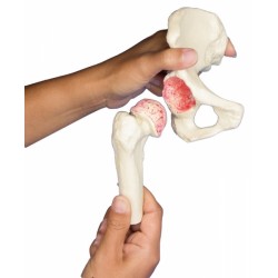 Modèle du joint de hanche malade