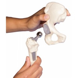 Modèle du joint de hanche avec implant