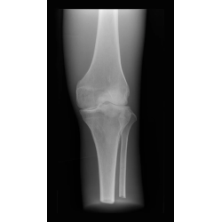 Fantôme de test pour radiographie – Genou transparent teamalex