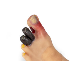 Simulateur médical – Jambe atteinte de pathologies Teamalex